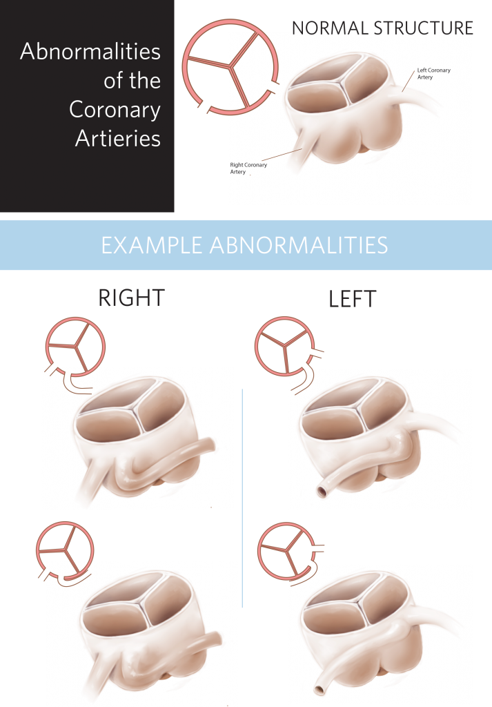 Abnormalities in the coronary arteries