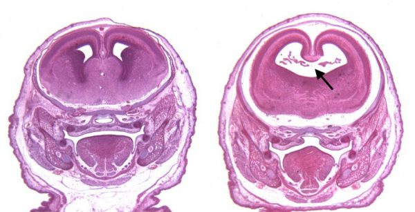 (Left) The brain of a control mouse. (Right) The brain of a mouse exposed to alcohol and a cannabinoid on the 8th day of pregnancy.