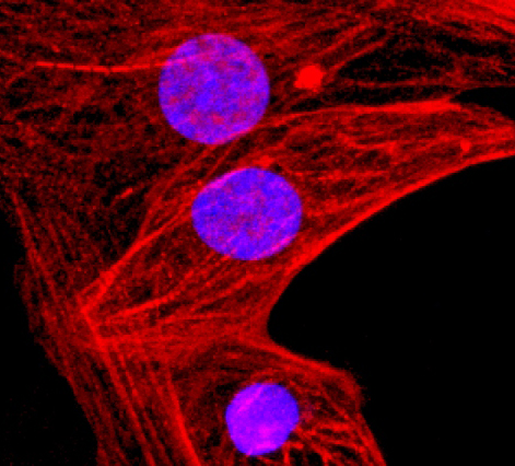 Human heart muscle cells derived from triple-engineered stem cells and “invisible” to the immune system. Red is troponin, a protein involved in muscle contraction. Blue is the nucleus. Cells like these could eventually be used to treat heart failure.