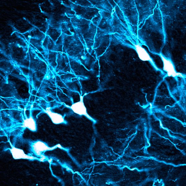 This image shows AAV therapy affecting pyramidal neurons in the hippocampus. (Blake Albright, Asokan Lab)