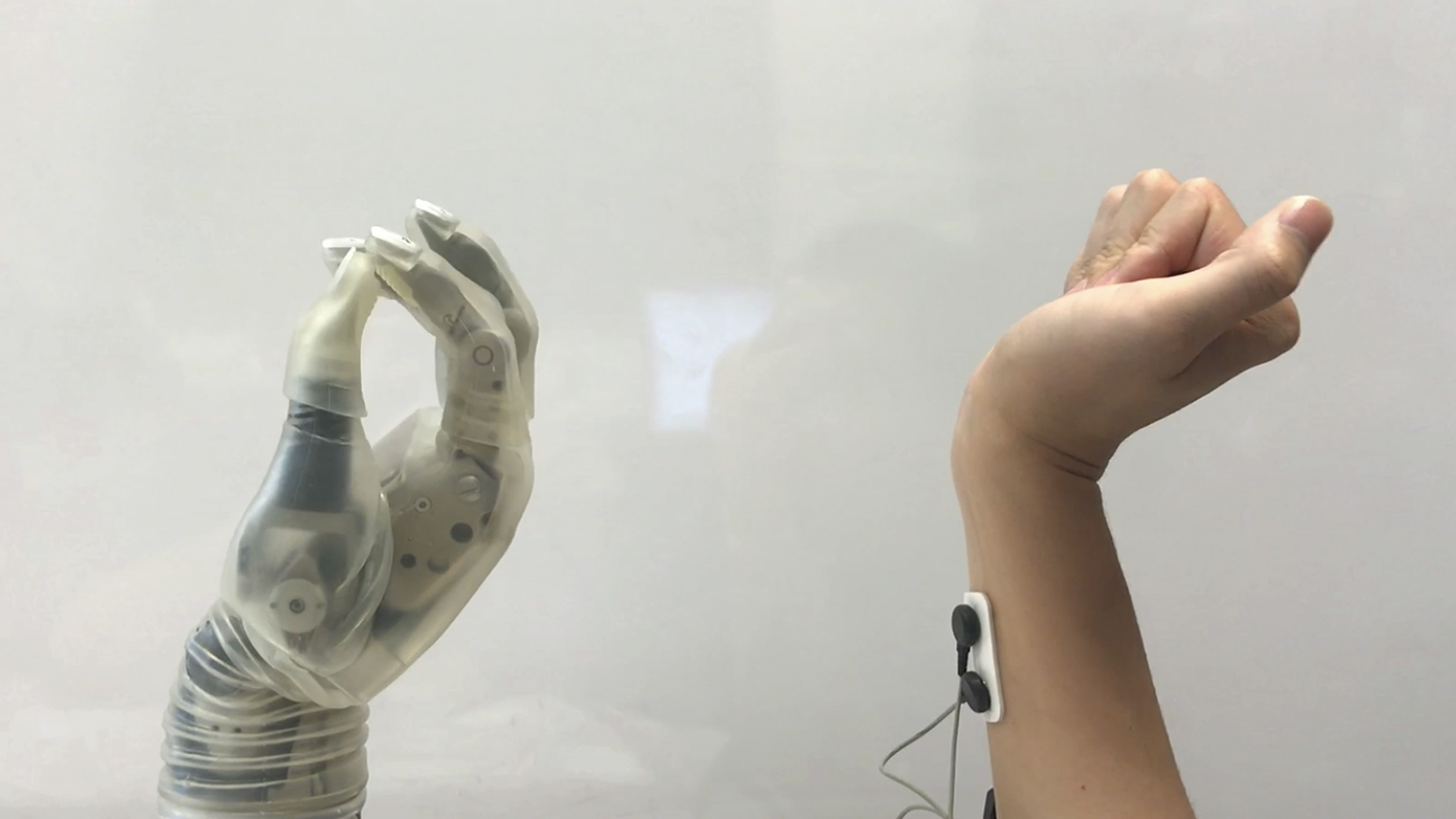 New Tech May Make Prosthetic Hands Easier for Patients to Use