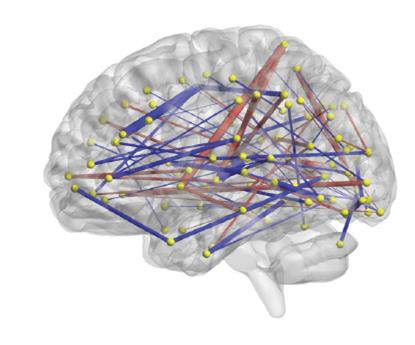 Researchers use MRIs to make connections between brain regions to predict which high-risk infants will develop autism.