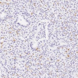 When IL35 is missing from preclinical models, cancer-killing immune cells (stained brown) can enter tumors.