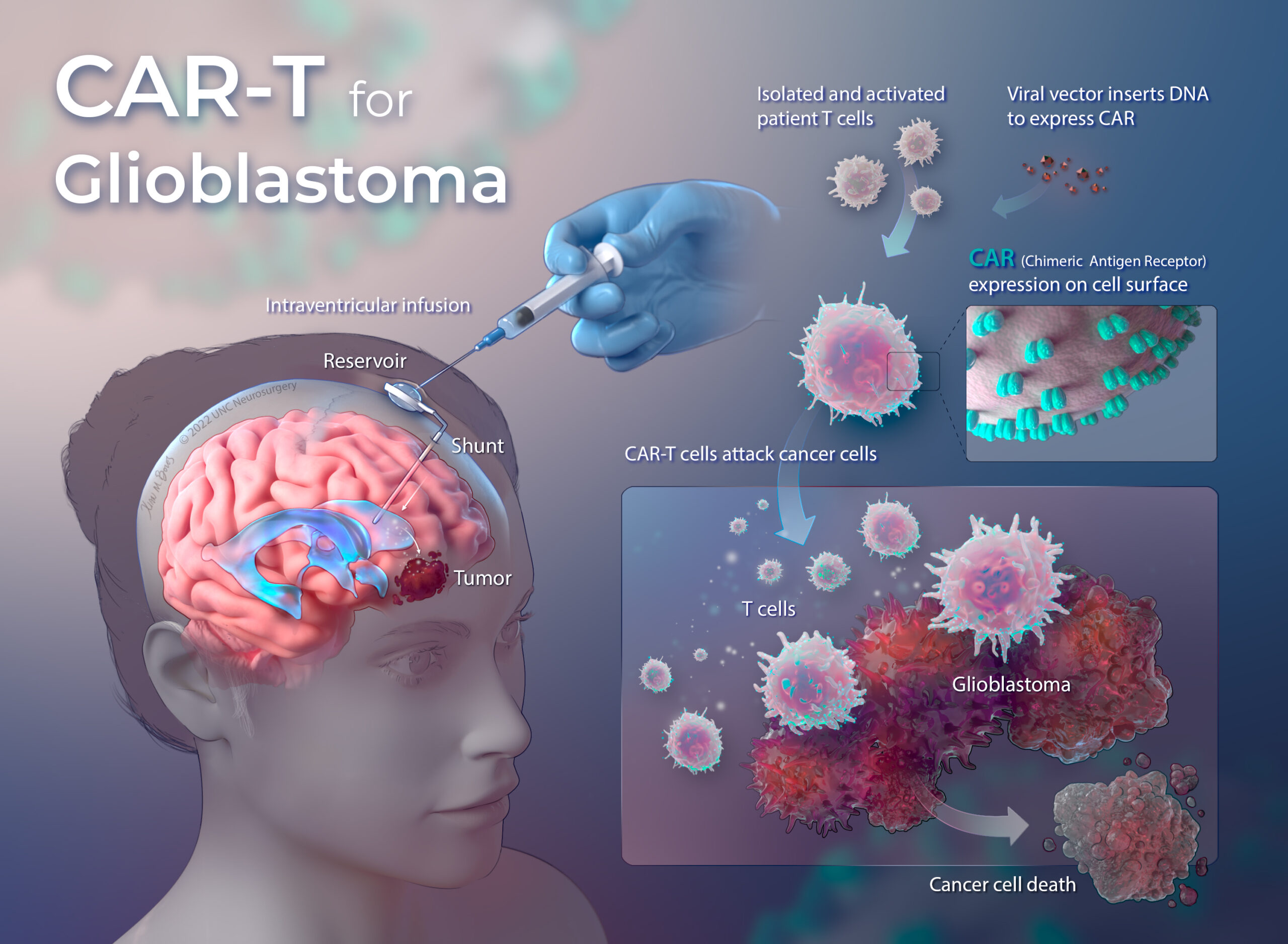 Phase I Clinical Trial Using CART for Glioblastoma to Begin at UNC
