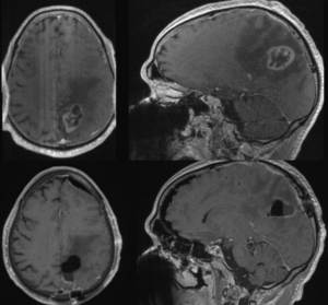 Researchers Leverage Cell Self-Destruction to Treat Brain Tumors