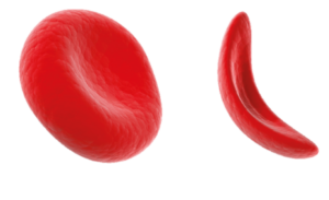 Sickle Cell Disease Continues to Face Underfunding, Lack of Research