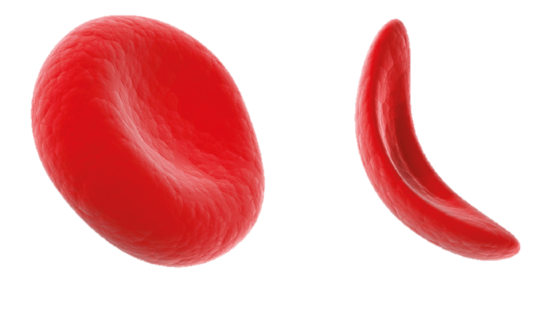 sickle cell vs normal cell