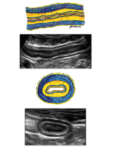 An ultrasound image. On the top is an image of the bowel in the coronal plane. On the bottom is a sagittal (or cross section) of the bowel.